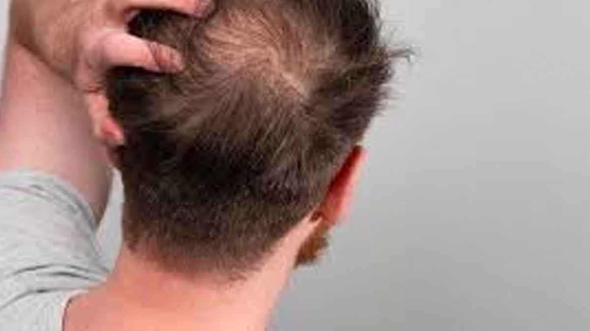 do you know that these are the reasons for hair fall 