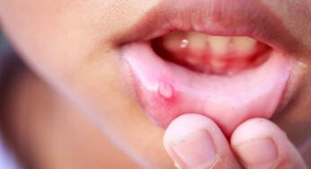 నోటి పూత స‌మ‌స్య‌తో ఇబ్బందులు ప‌డుతున్నారా ? అయితే ఈ 6 చిట్కాల‌ను పాటించండి..!