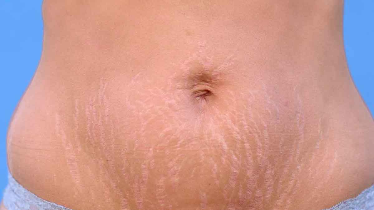 how to get rid of stretch marks after delivery 
