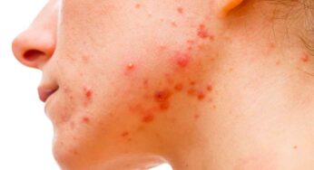 మొటిమ‌లు ఇబ్బందుల‌కు గురి చేస్తున్నాయా..? ఇలా చేయండి..!