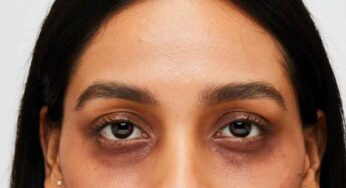 డార్క్ స‌ర్కిల్స్‌తో ఇబ్బంది ప‌డుతున్నారా..? ఈ చిట్కాల‌ను పాటించండి..!