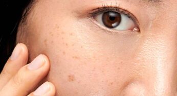 పైసా ఖ‌ర్చు లేకుండా ముఖంపై న‌ల్ల‌ని మ‌చ్చ‌ల‌ను ఇలా తొల‌గించుకోండి..!