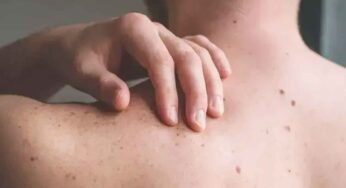 చర్మ స‌మ‌స్య‌లు అధికమ‌య్యే స‌మ‌యం.. ఈ జాగ్ర‌త్త‌లు త‌ప్ప‌నిస‌రి..!