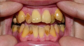 పళ్ళు పచ్చగా ఉన్నాయా? అయితే ఈ చిట్కాలను పాటించండి…!