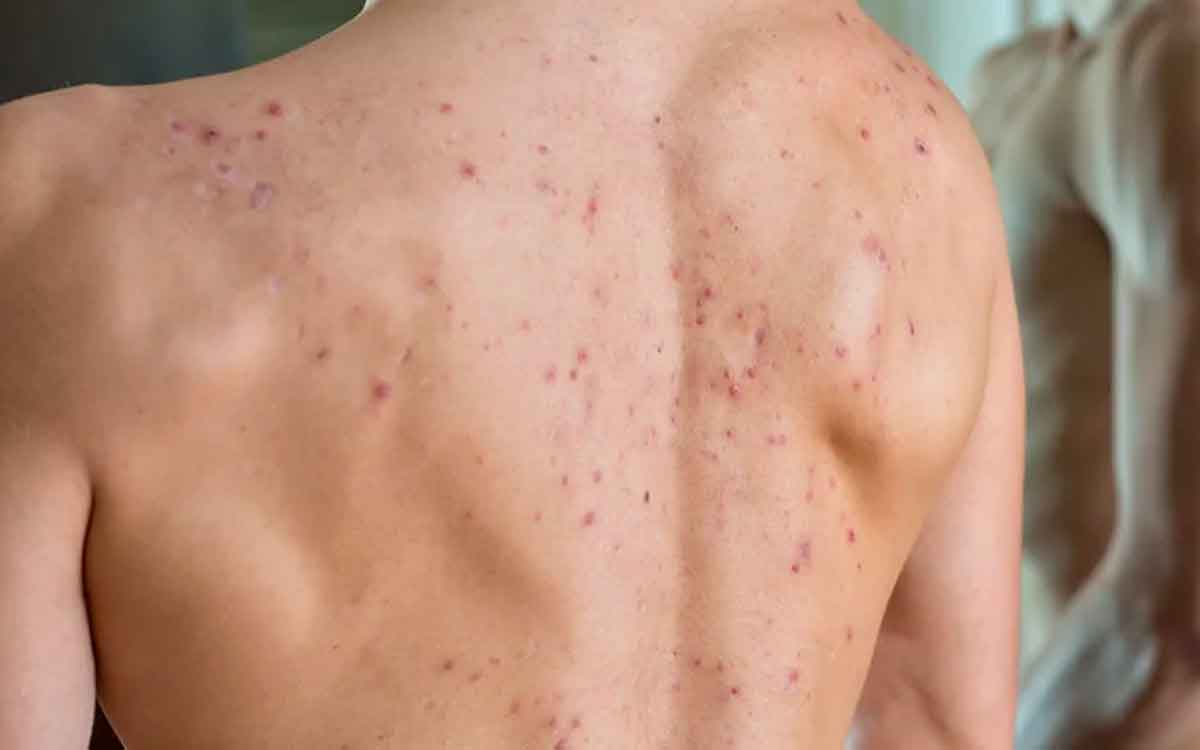 how to remove acne on back 
