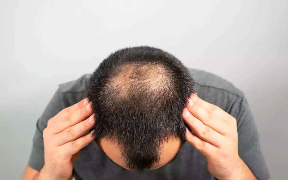 why bald head comes to gents only 