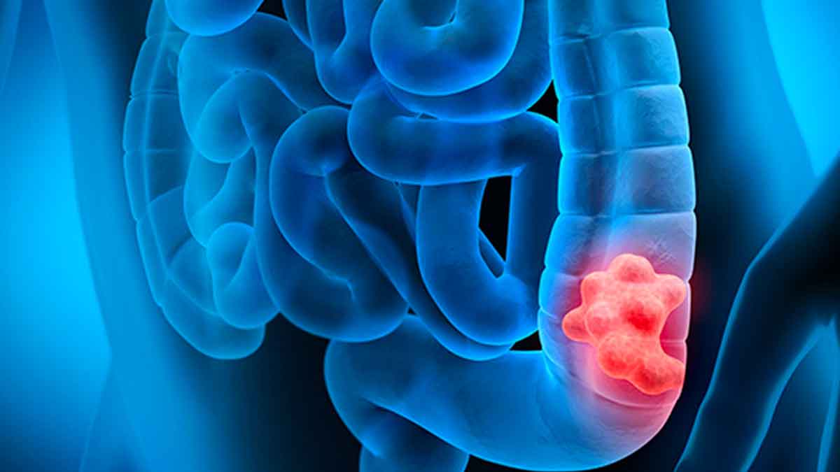 men must know these about colon cancer 