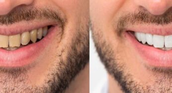 మీ దంతాలు స‌హ‌జ‌సిద్ధంగా తెల్ల‌గా మారాలంటే ఇలా చేయండి..!